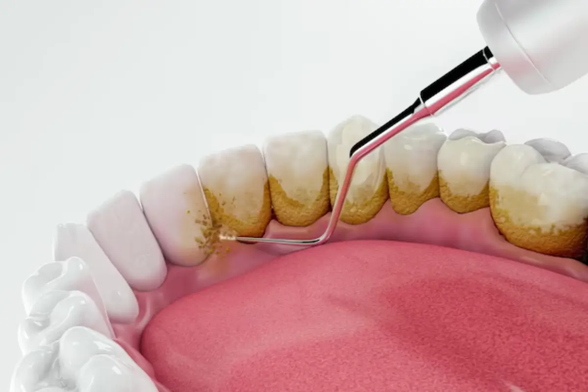 Teeth Cleaning - Beauty Lounge by Joelle