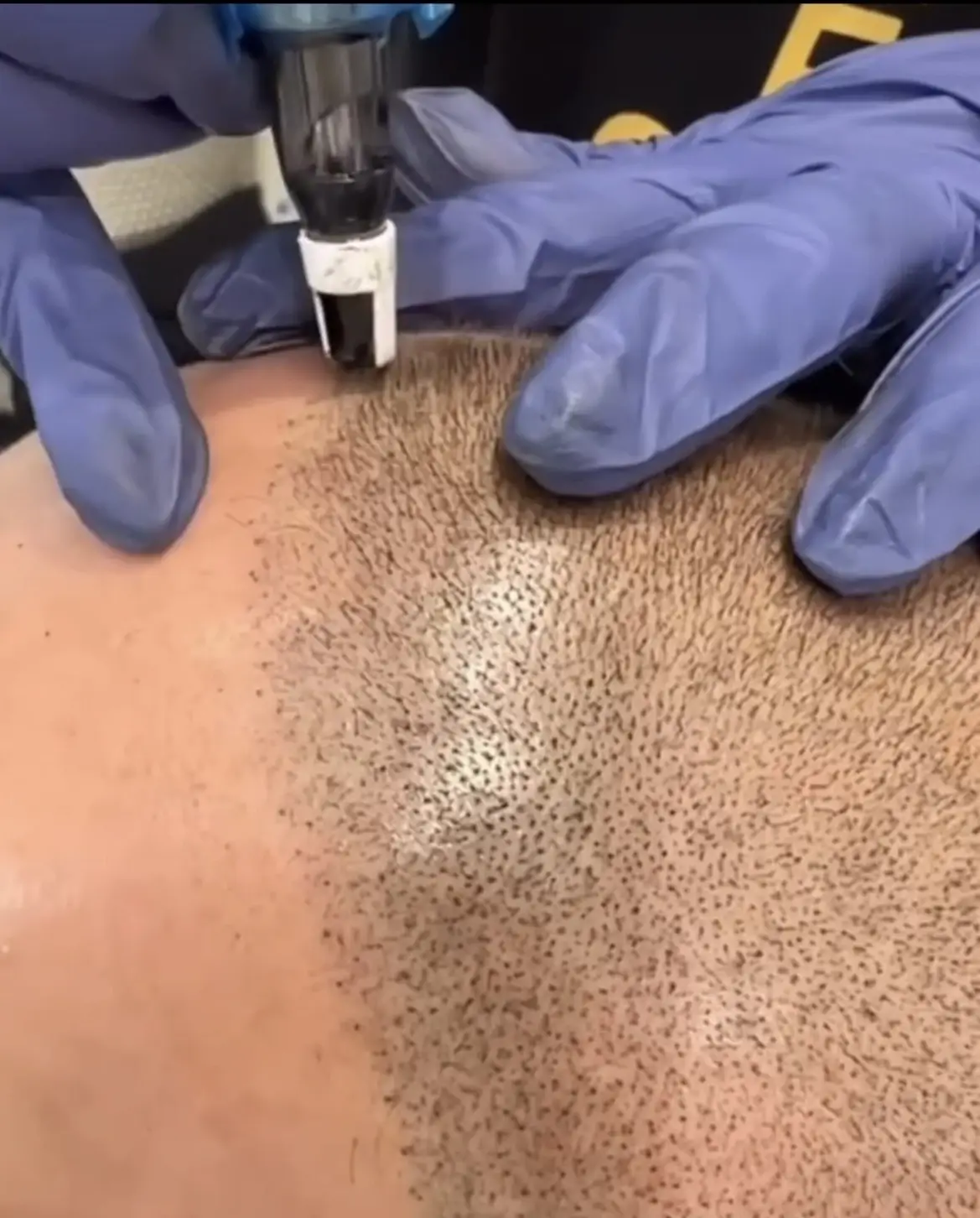 What Is Scalp Micropigmentation - Beauty Lounge by Joelle What Is Scalp Micropigmentation