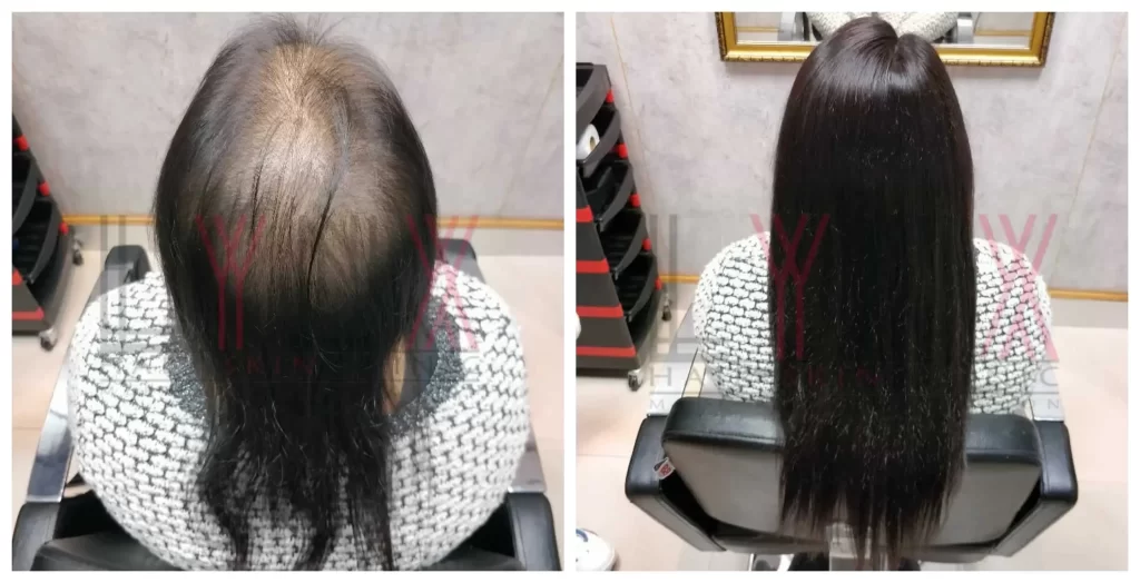 Medical Wigs - Real Results 1 - Beauty Lounge by Joelle Medical Wigs - Real Results 1