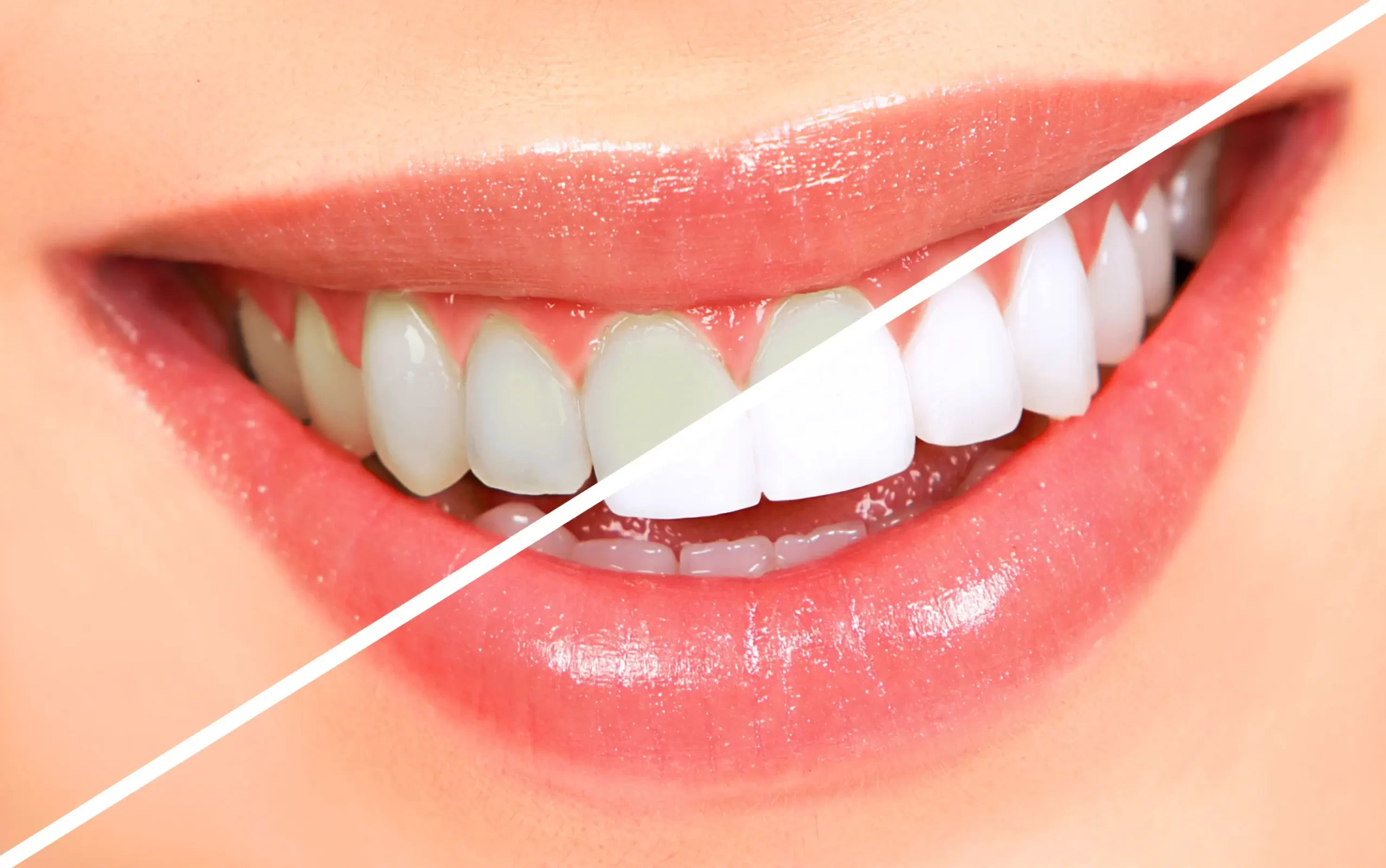 Teeth Whitening - Beauty Lounge by Joelle Teeth Whitening
